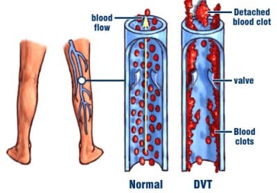 A diagram of blood flow and vein formation.