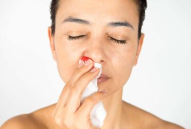 Nosebleeds first aid with woman holding tissue to her nose